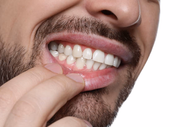 Perio Protect Treatment at Tulip Dental Irvington
